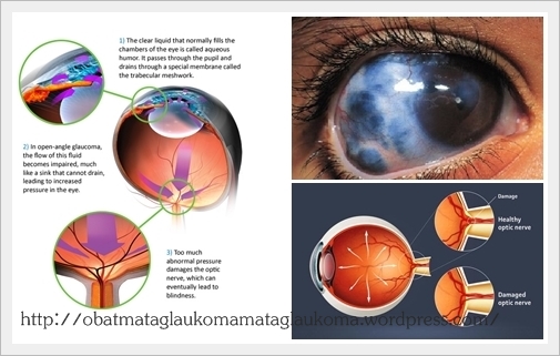 Глаукома латынь. Стабилизированная и нестабилизированная глаукома.